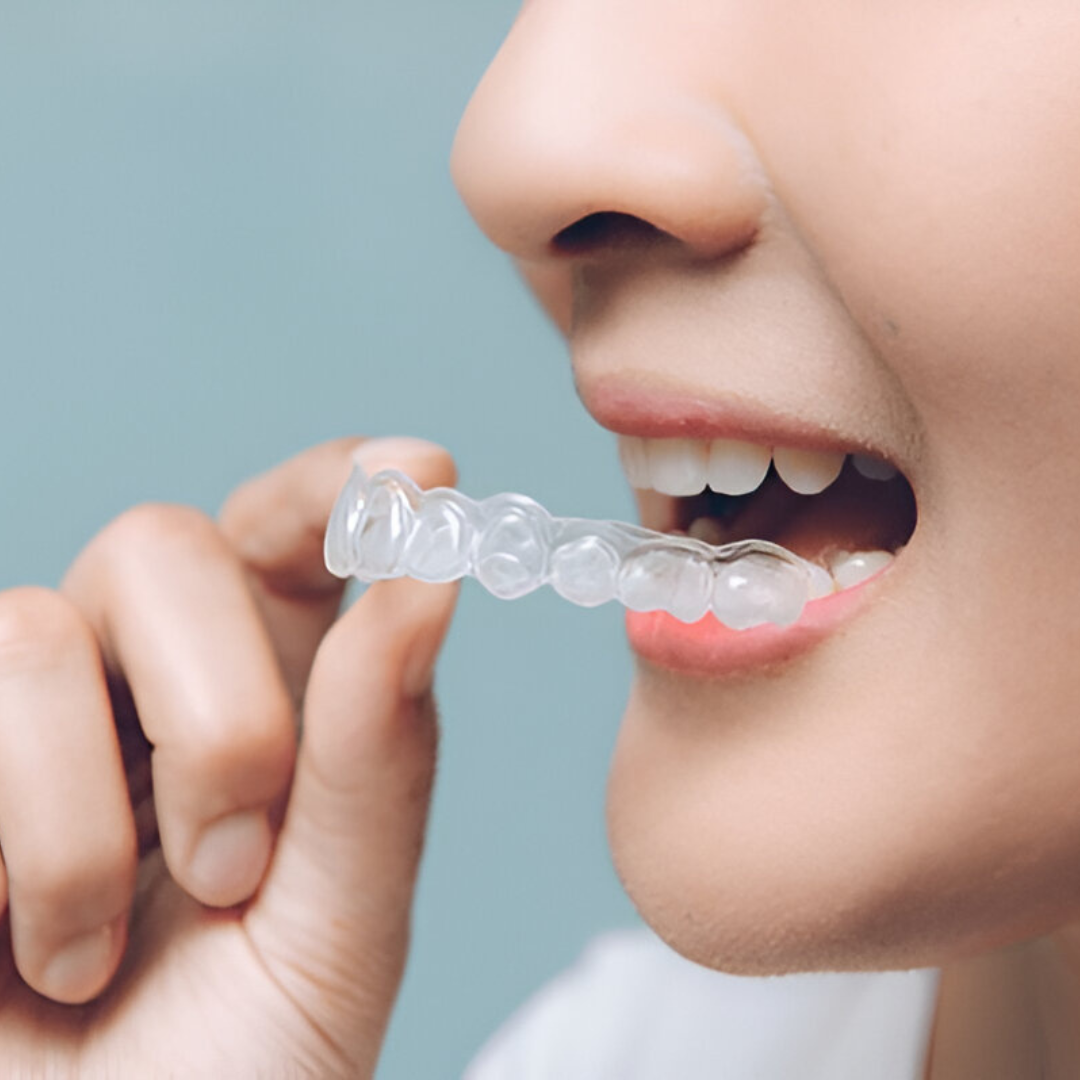 Removable Invisalign