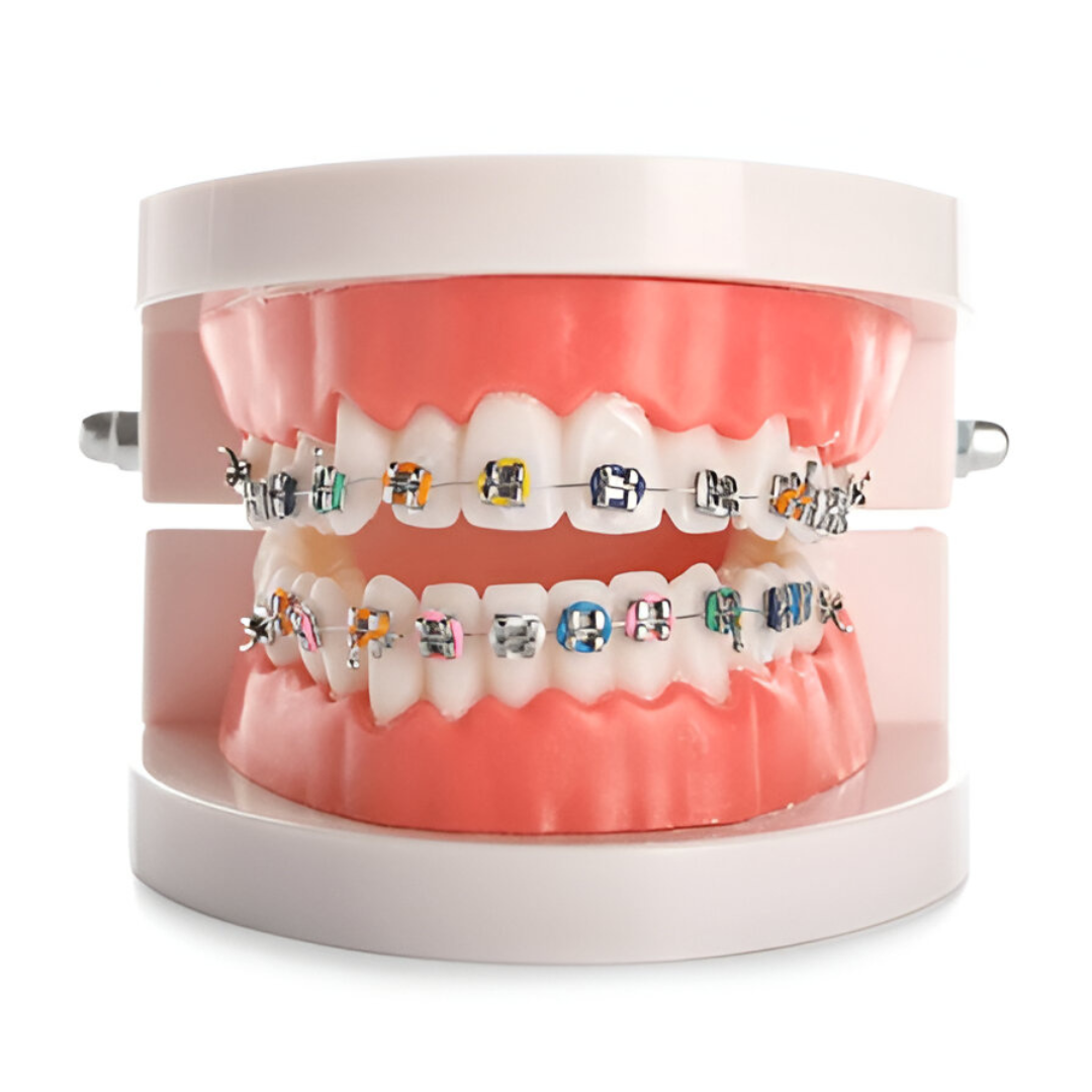 Best Dental Braces in Chennai