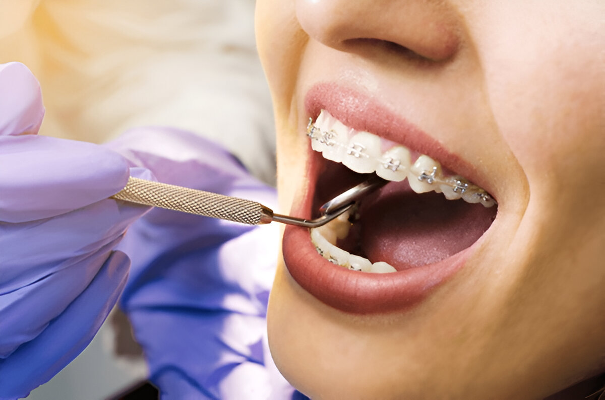 Best Dental Braces in Chennai