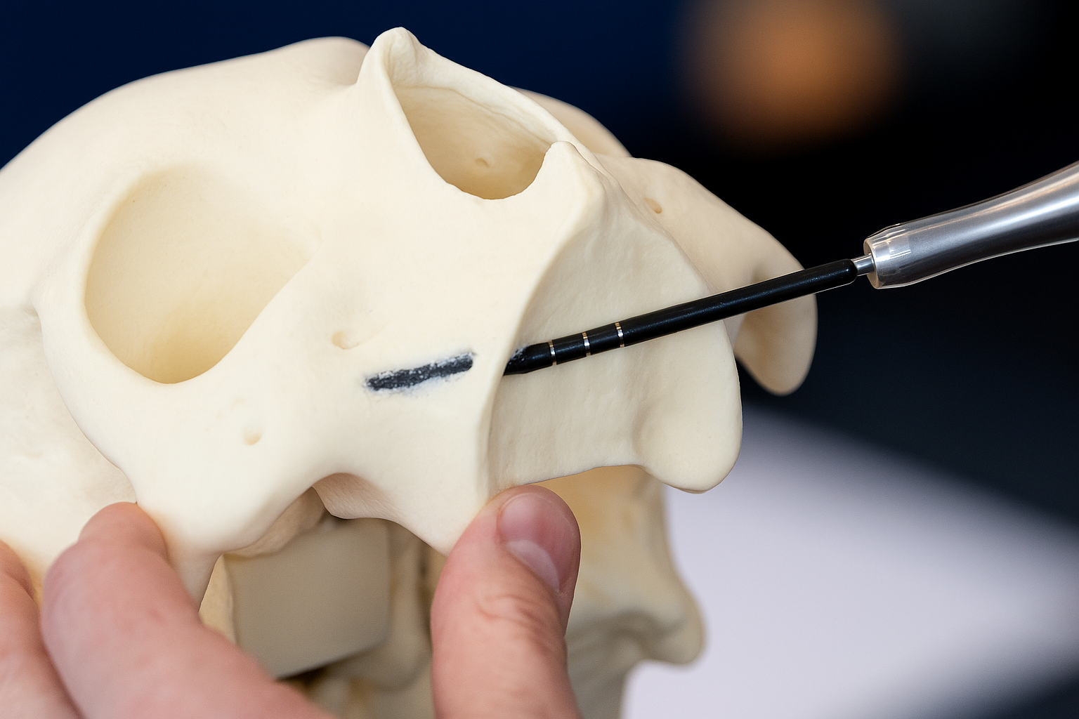 Zygoma Dental Implants in Chennai