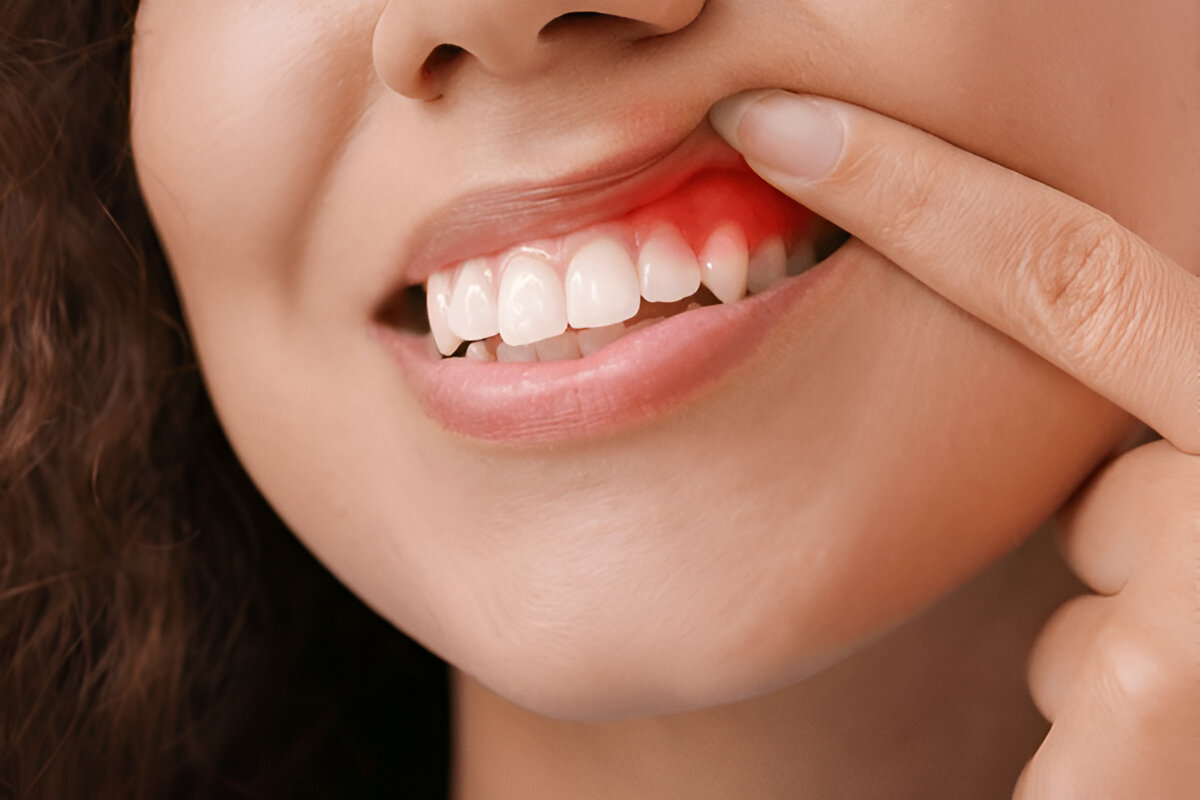 Best Gum Treatment in Chennai