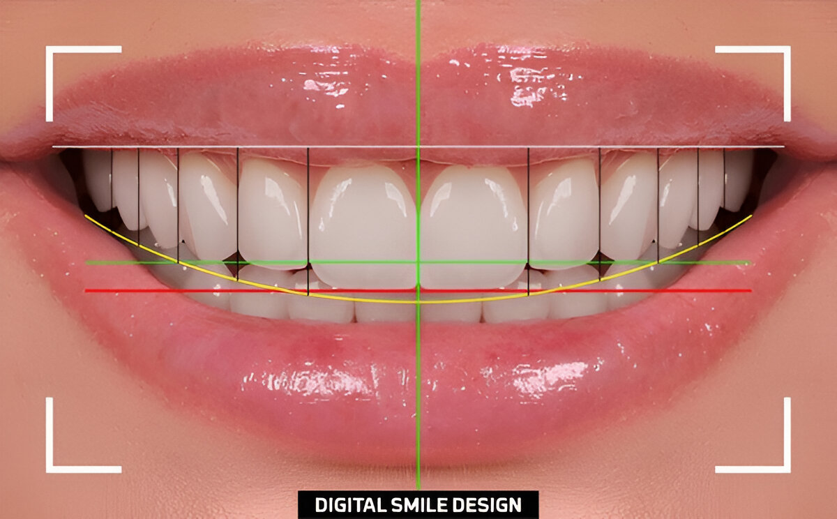 Computerized Crowns in Chennai