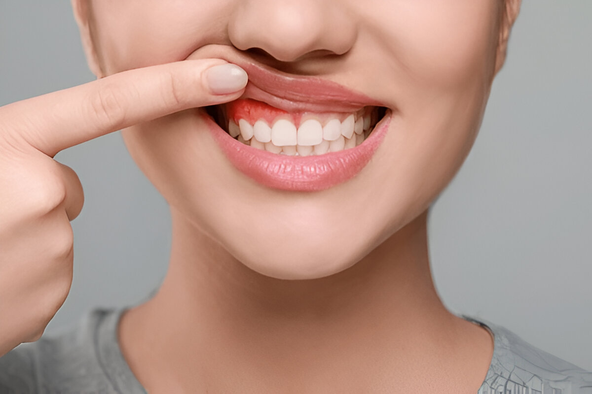 Best Gum Treatment in Chennai