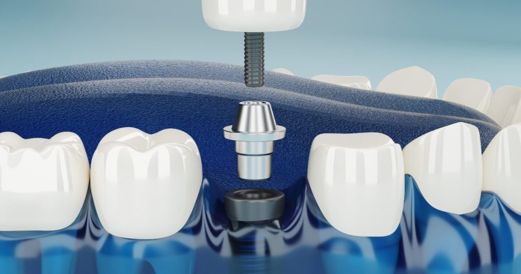 Best Dental Implant in Chennai