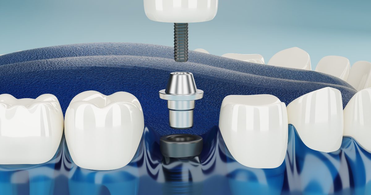 Best Dental Implant in Chennai