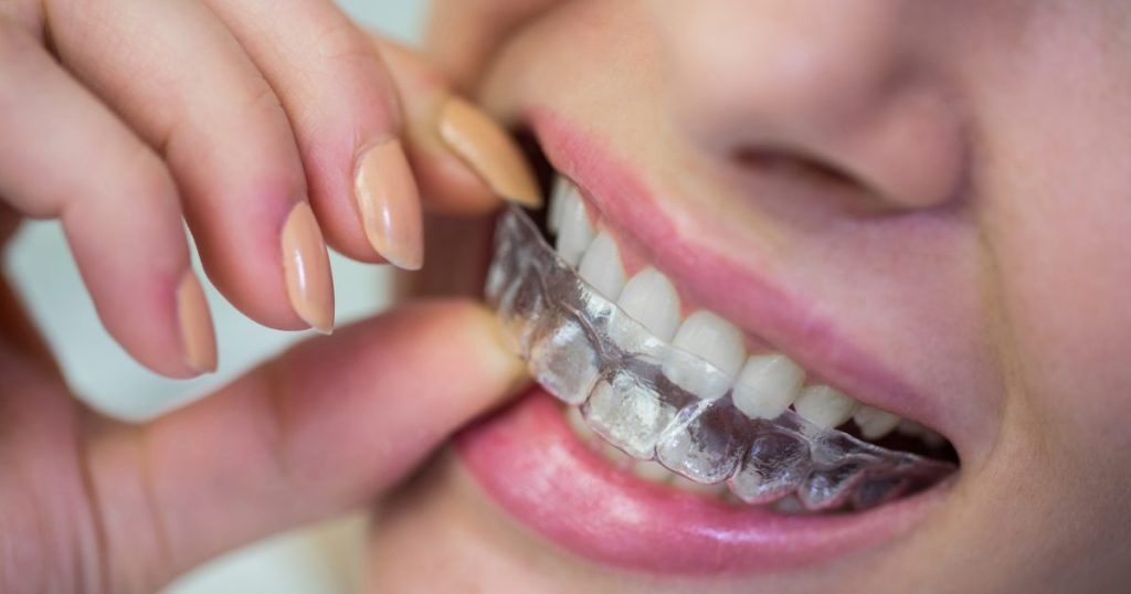 What is Invisalign? A Complete Guide to Clear Aligner Treatment