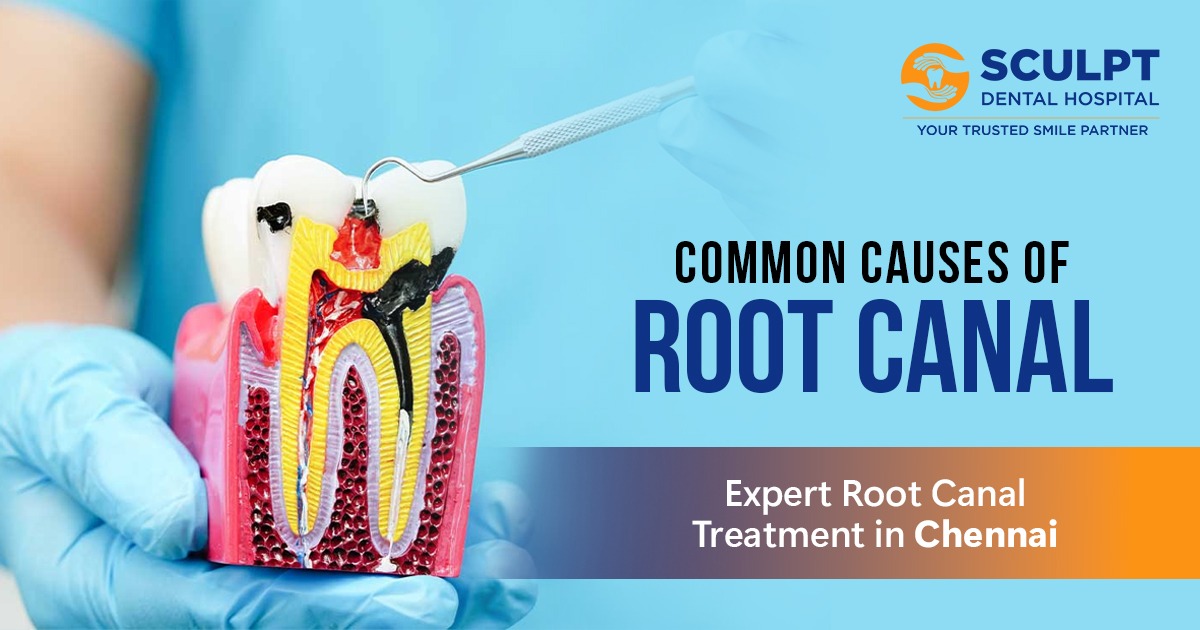 Root Canal Treatment in Chennai