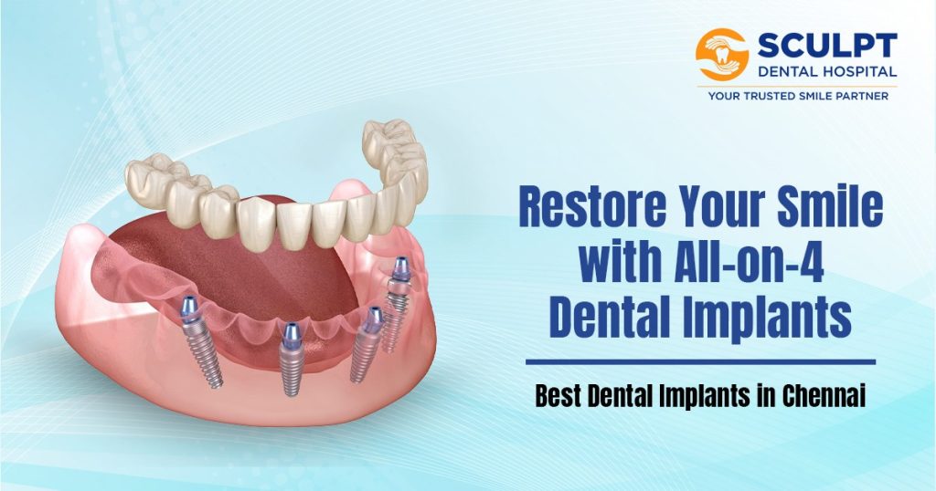 The Benefits of All-on-4 Dental Implants for Full Tooth Restoration
